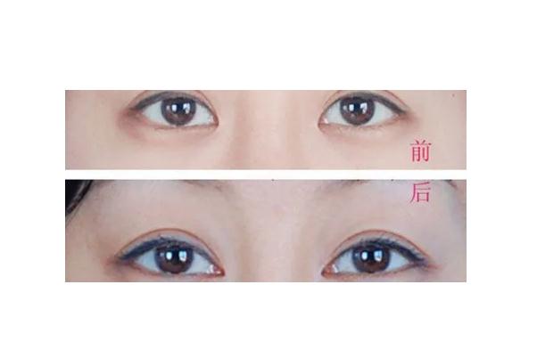 開(kāi)眼角有必要嗎 開(kāi)眼角會(huì)長(zhǎng)回去嗎