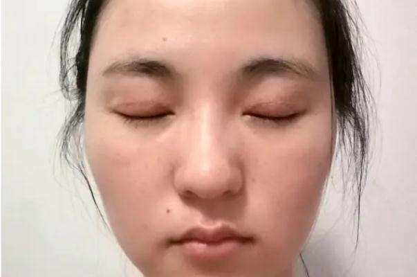 開(kāi)眼角有必要嗎 開(kāi)眼角會(huì)長(zhǎng)回去嗎