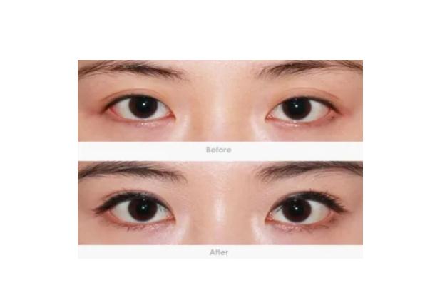 開(kāi)眼角的副作用 開(kāi)眼角的線沒(méi)拆干凈有影響嗎