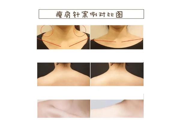 瘦肩針有什么危害和副作用 瘦肩針一針大概多少錢(qián)