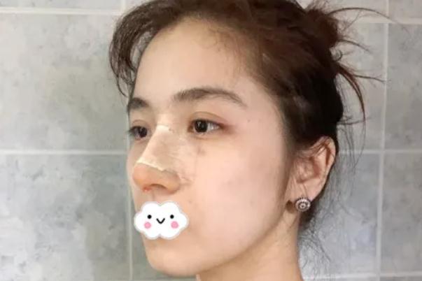 膨體隆鼻會一年比一年矮嗎 膨體隆鼻的優(yōu)點(diǎn)和缺點(diǎn)
