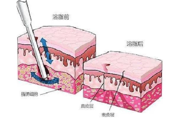 溶脂針會(huì)導(dǎo)致皮膚松弛嗎 溶脂針會(huì)影響月經(jīng)嗎