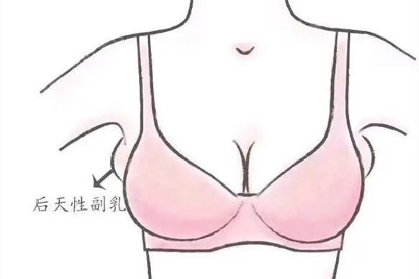 副乳切除手術(shù)是全麻還是局麻 副乳切除手術(shù)后多久可以正?；顒?></p><h3>副乳切除手術(shù)可以進醫(yī)保嗎</h3><p>副乳手術(shù)醫(yī)保能不能報銷，要看副乳腺到底是屬于什么情況，比如像病理型的副乳腺手術(shù)，副乳腺里面長了腫瘤，或者乳腺癌。這部分病人在切除腫瘤同時把副乳腺切除，這部分的費用是可以醫(yī)保報銷的。但是純粹的并沒有其他病變，為了美容目的進行副乳手術(shù)，這部分病人醫(yī)保是不予報銷的。</p><p><br/></p> </div>
<div align=