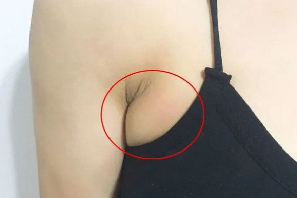 副乳切除手術什么季節(jié)做最好 副乳切除手術可以在整形醫(yī)院做嗎