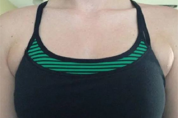 副乳切除手術什么季節(jié)做最好 副乳切除手術可以在整形醫(yī)院做嗎