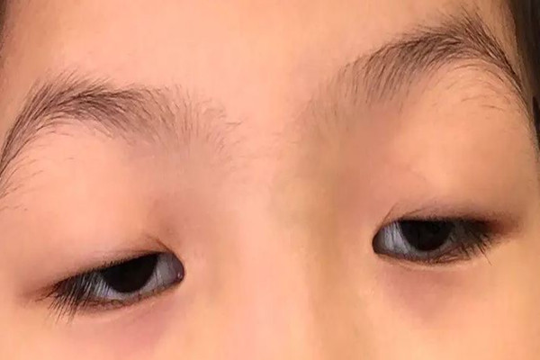 武漢上眼瞼下垂哪個醫(yī)院做的好 武漢上眼瞼下垂修復手術要多少錢