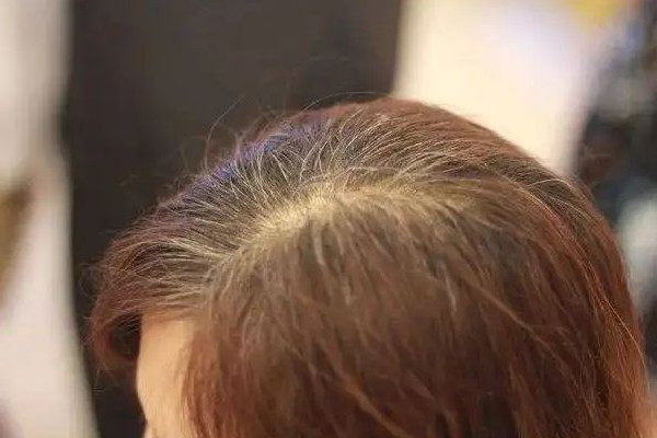 白頭發(fā)吃中藥能調理好嗎 白頭發(fā)多久能變黑